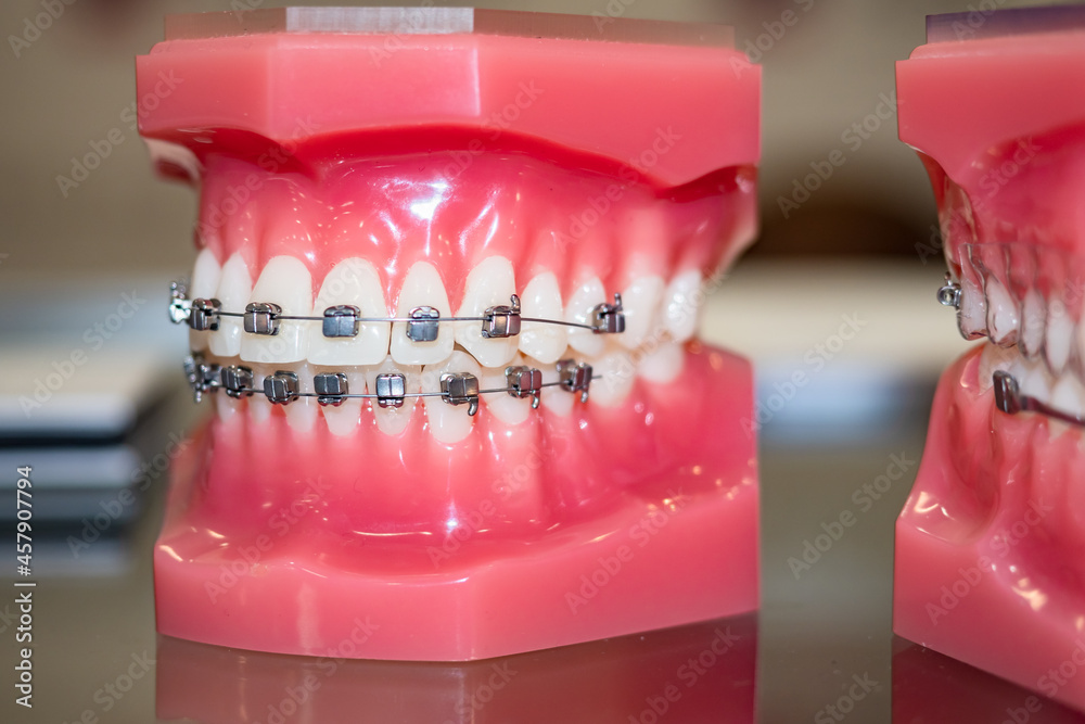 Orthodontic bracket or brace. Demonstration model of the teeth and