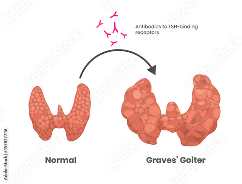 Grave's disease cause. Antithyroid antibodies