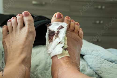 Bloody bandages on a foot with stiches after a bunion surgery photo