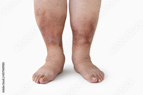 Fotografía Swelling of the leg with inflammation in diabetic nephropathy in a woman, close-up