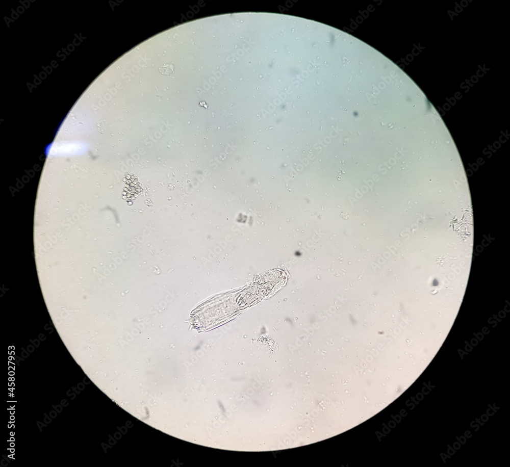 Schistosoma Haematobium Parasite in human urine specimen under