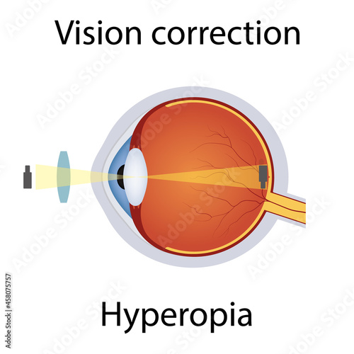 Vision Correction of Hyperopia Illustration. Eyesight Disorders. Eyes Defect Corrected by Convex Lens Concept. Detailed Anatomy Eyeball with Hyperopia Defect. Isolated Vector