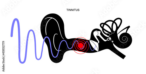 Tinnitus disease concept