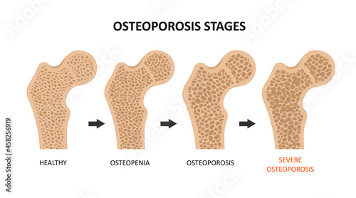 Osteoporosis stages. Bone spongy structure vector illustration, normal, osteopenia and osteoporosis photo