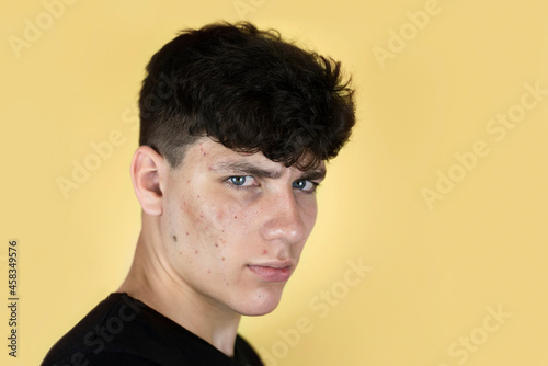 Many pimples on the face of a teenage boy, it is clear that the guy is unpleasant, he suffers from acne and blackheads, the concept of healthy skin. The guy needs to go to a dermatologist