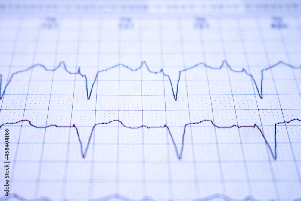 Close-up of an EKG tracing of a patient with a cardiac pacemaker. Pacemaker beats