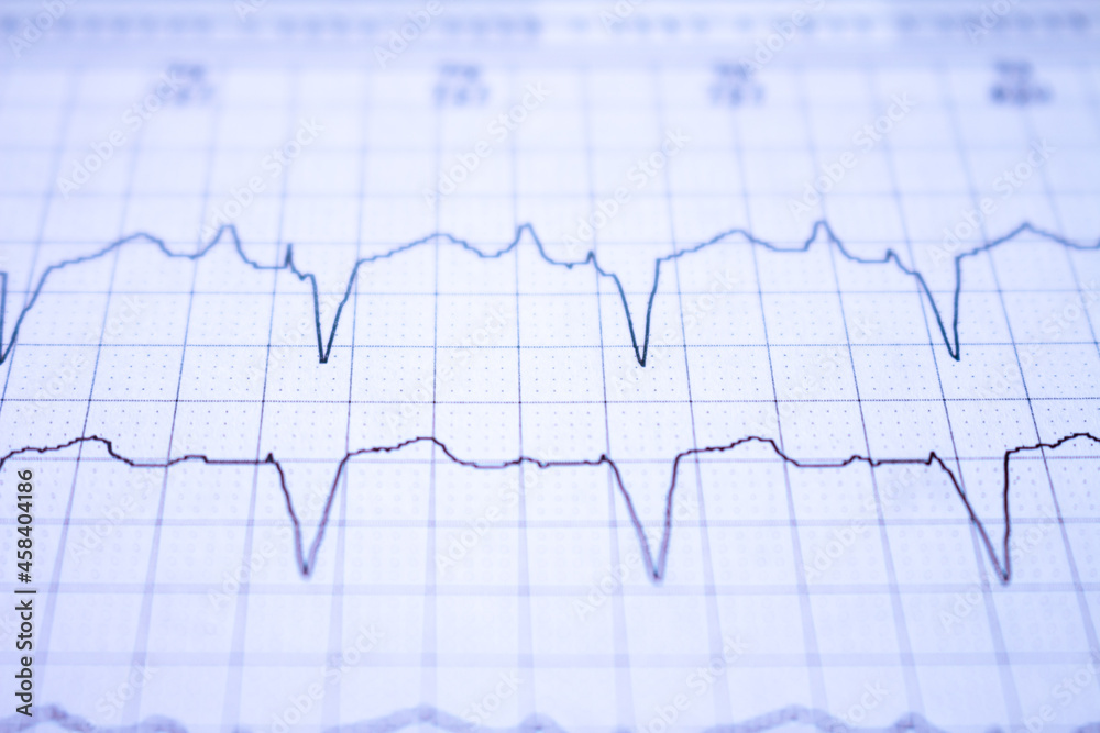 Close-up of an EKG tracing of a patient with a cardiac pacemaker. Pacemaker beats Close-up of an EKG tracing of a patient with a cardiac pacemaker. Pacemaker beats