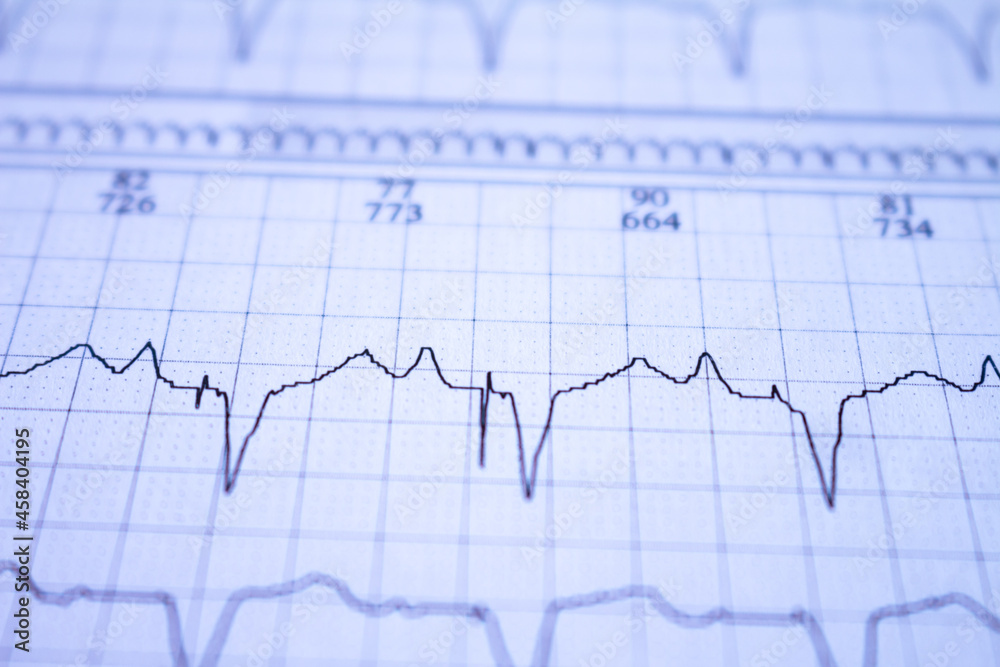 Close-up of an EKG tracing of a patient with a cardiac pacemaker. Pacemaker beats recorded on paper. Close-up of an EKG tracing of a patient with a cardiac pacemaker. Pacemaker beats recorded on paper.