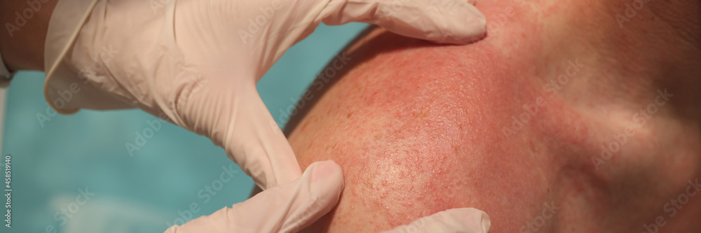 Doctor dermatologist examining rash on skin of man shoulders using gloves closeup Doctor dermatologist examining rash on skin of man shoulders using gloves closeup