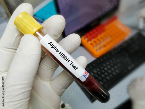 Blood sample for α-Hydroxybutyrate dehydrogenase (α-HBDH) test, diagnosis of myocardial infraction 