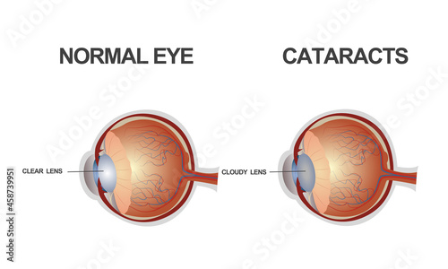 The structure of the eye. Cataract.