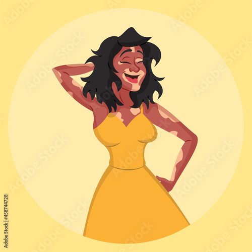 Young woman with vitiligo smiling with hand at hair