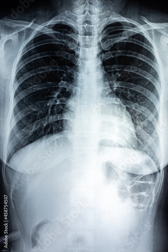 Film X-ray of breast a person
