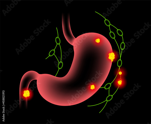 Stomach cancer anatomy