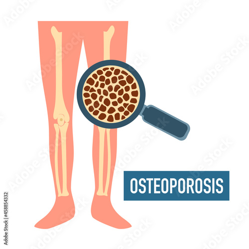 Human bone with osteoporosis concept vector illustration on white background.