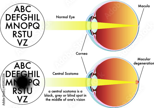 Medical illustration of the symptoms of central scotoma.