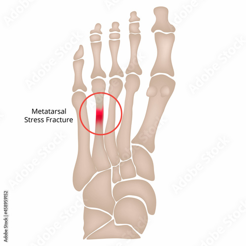 Stress fracture. Marching fracture of the foot. Fracture of the metatarsal bones in the foot. Anatomical structure of the foot. Skeleton. Broken bones. Vector illustration on isolated background.