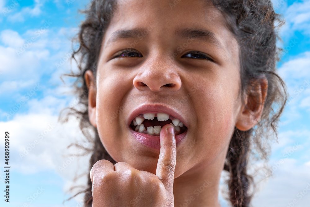 Close up girl mouth with crooked broken teeth and odontolith, will need a dental appliance. Close up girl mouth with crooked broken teeth and odontolith, will need a dental appliance.