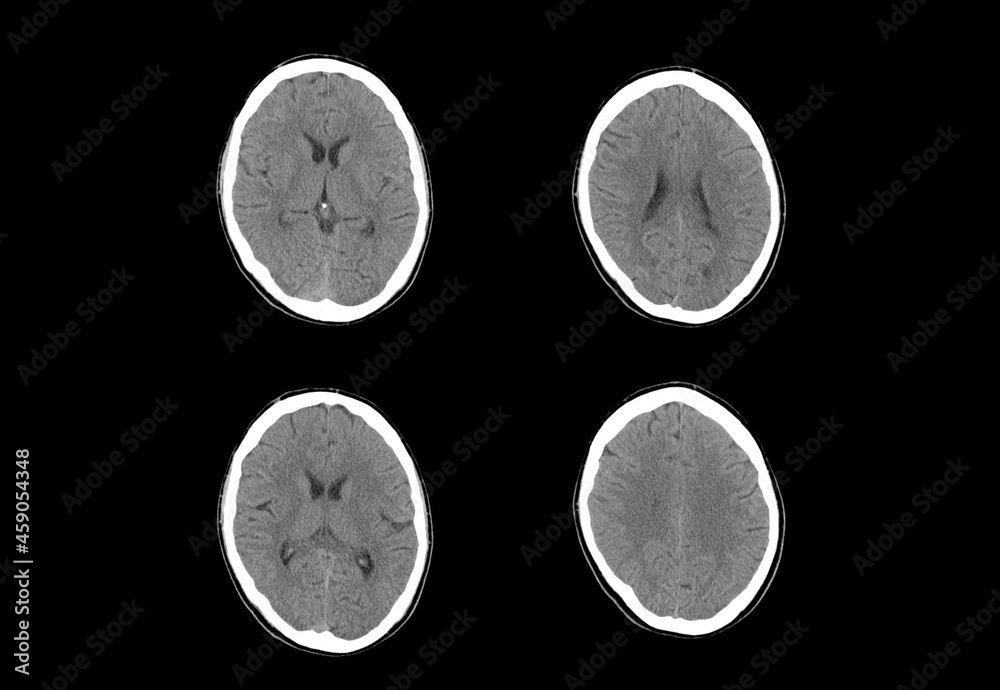 Brain ct scan and MRI images Stock Photo | Adobe Stock