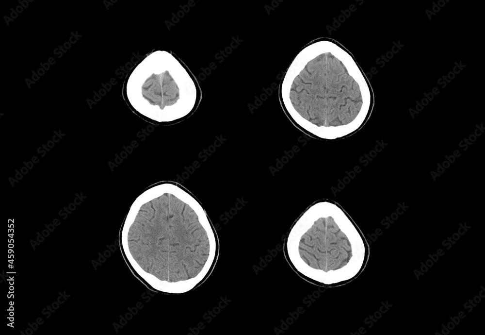 Brain ct scan and MRI images Stock Photo | Adobe Stock