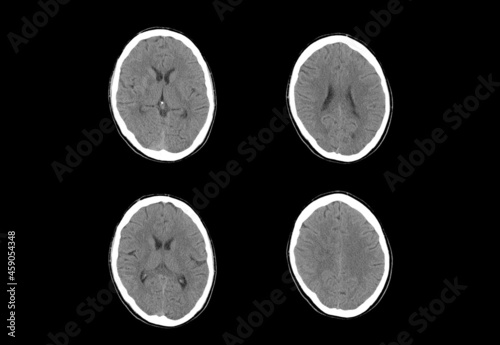 Brain ct scan and MRI images