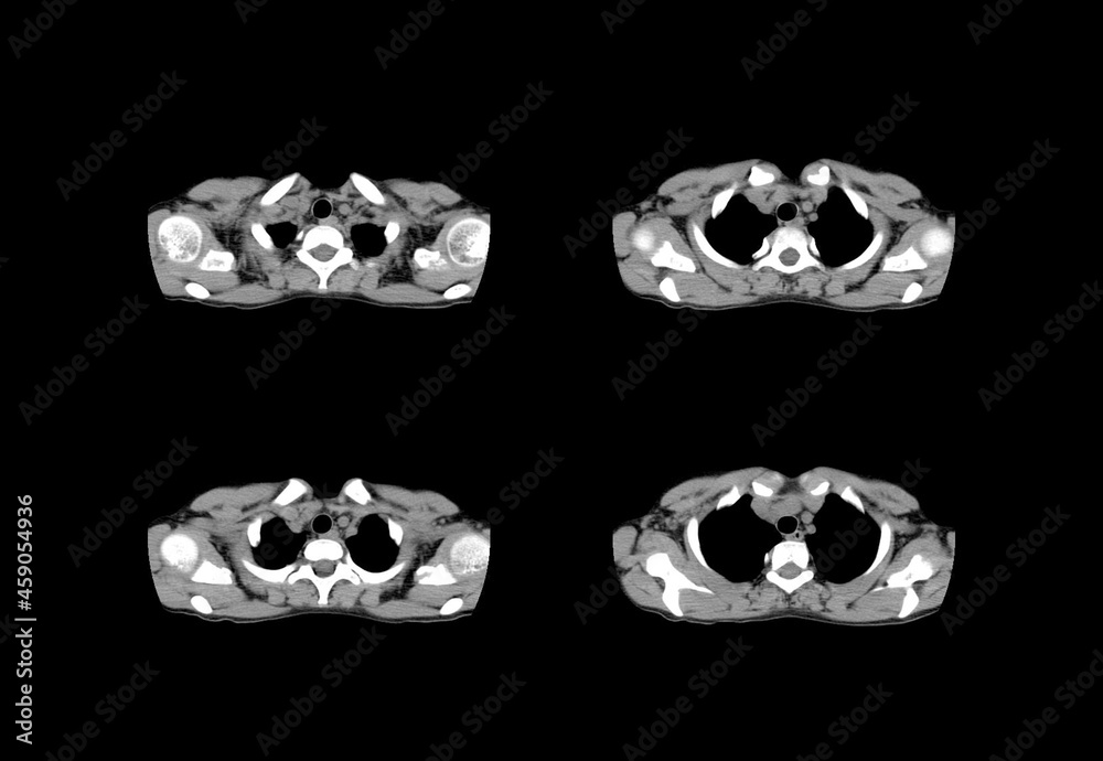 Ct scan and MRI chest unique professional images Ct scan and MRI chest unique professional images