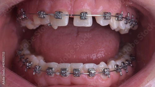 Dental tooth brackets In-Oral Photo Protocol