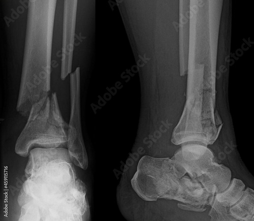 Photos x ray of a broken foot  cominutive fracture on tibia and fibula