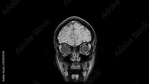 Computed medical tomography MRI upscaled scan of healthy young female head. Front view. Discrete slices. Original black-and-white on black background.