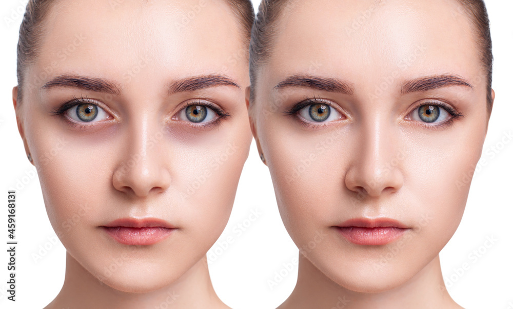 Young woman with bruises under eyes before and after treatment. Young woman with bruises under eyes before and after treatment.