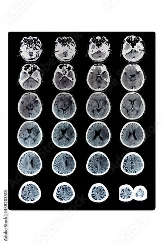 Closeup image of a CT scan with x-ray film of the human brain with ischemic stroke symptom computed tomography
