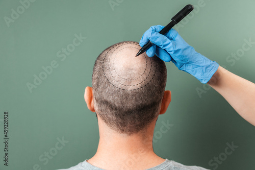 Trichologist outlines the area of baldness on the client's head with a marker. Rear view. Green background. The concept of alopecia and mesotherapy photo