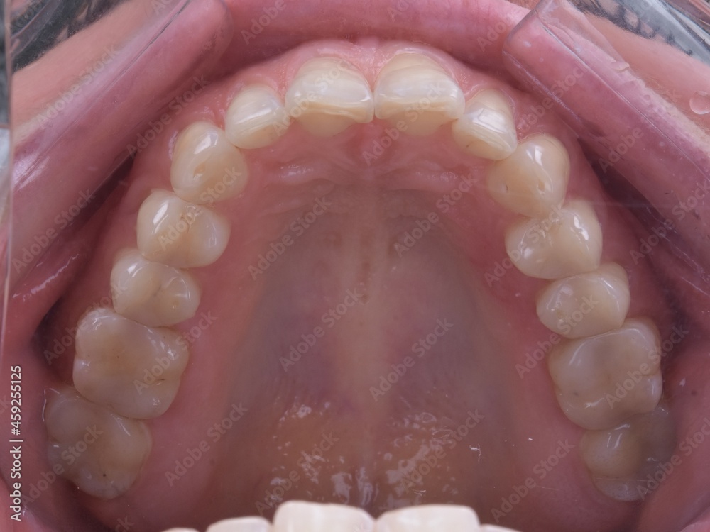 Obraz premium Tooth In-oral Photo