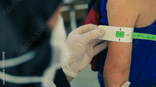 Measuring malnutrition using strap MUAC mid-upper-arm-circumference. A doctor examines child malnutrition photo