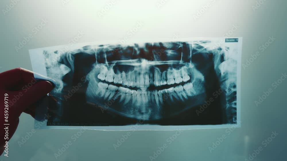 Xray examination of the jaw. The doctor examines a panoramic image of