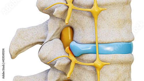 Картината върху платно Herniated disc with spinal nerve compression 3D rendering illustration lateral view isolated on white background