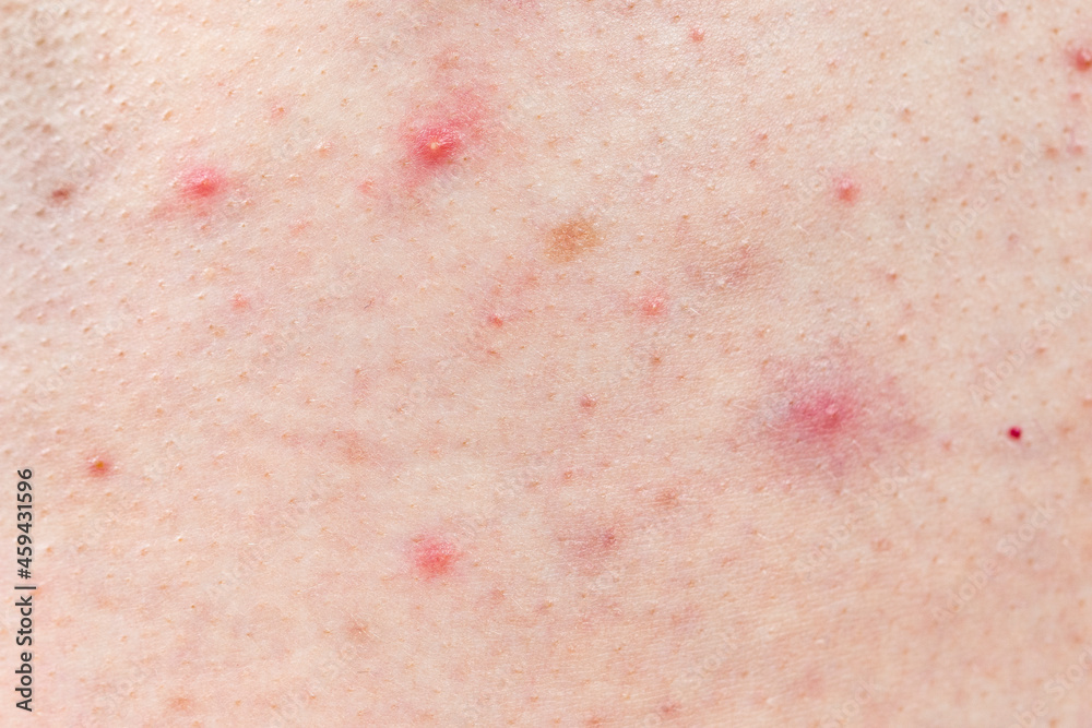 Fototapeta premium Skin background texture with pimples and blackheads. problematic skin close up. acne diseases