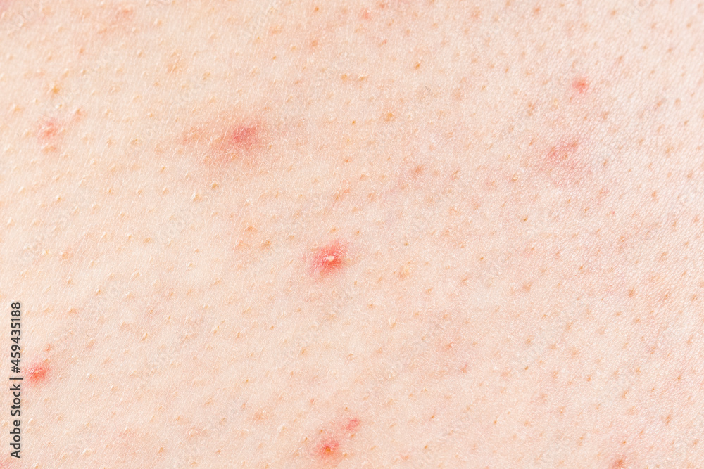 Skin background texture with pimples and blackheads. problematic skin close up. acne diseases Skin background texture with pimples and blackheads. problematic skin close up. acne diseases