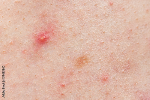 Skin background texture with pimples and blackheads. problematic skin close up. acne diseases