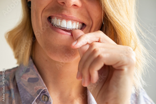 Beautiful smile and white teeth of a young blonde woman with invisible braces photo