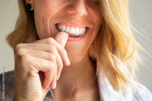 Beautiful smile and white teeth of a young blonde woman with invisible braces