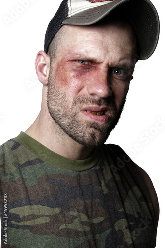 Male redneck with blackeye #2
