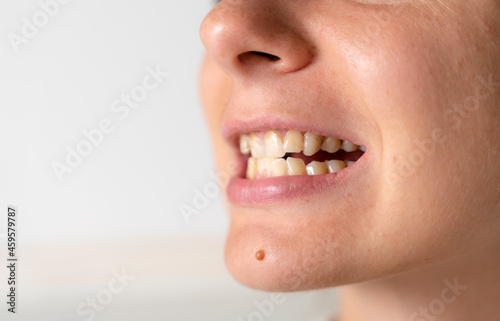 Crooked and yellow teeth. Woman has malocclusion. Adult orthodontics problem and treatment. Somatology medicine photo