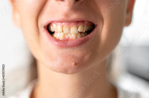 Crooked and yellow teeth. Woman has malocclusion. Adult orthodontics problem and treatment. Somatology medicine photo