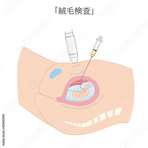 妊婦さんの絨毛検査の図解イラスト