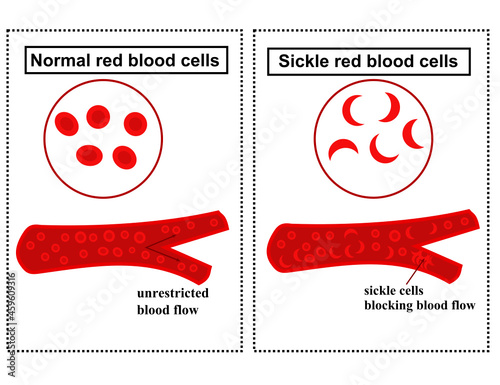 Normal red blood cell and sickle cell.Anaemia disease.Diagram or infographic.World sickle cell day.Erythrocytes.Blood flow concept.Vector illustration.