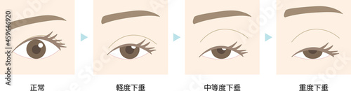 眼瞼下垂のイラスト