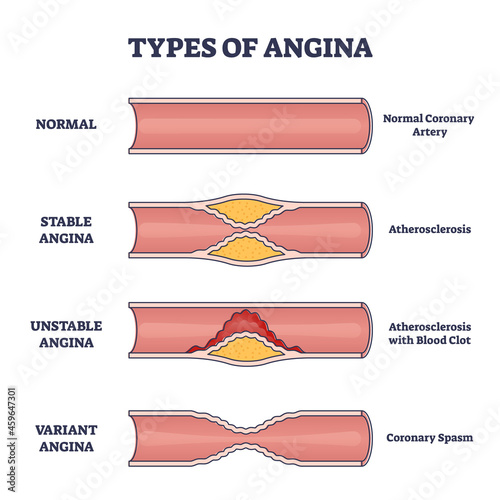 Types of angina as chest pain and heart problem explanation outline diagram. Educational anatomical normal, stable and unstable illness comparison with inner artery disease example vector illustration