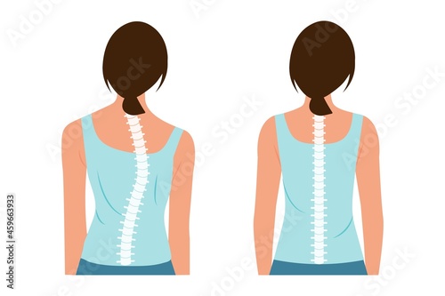 Good posture and bad posture. Chiropractic before after image. Scoliosis.Woman's body and backbone.