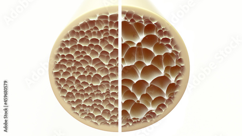 Foto healthy boneand and osteoporosis bone - direct comparison - 3D Rendering